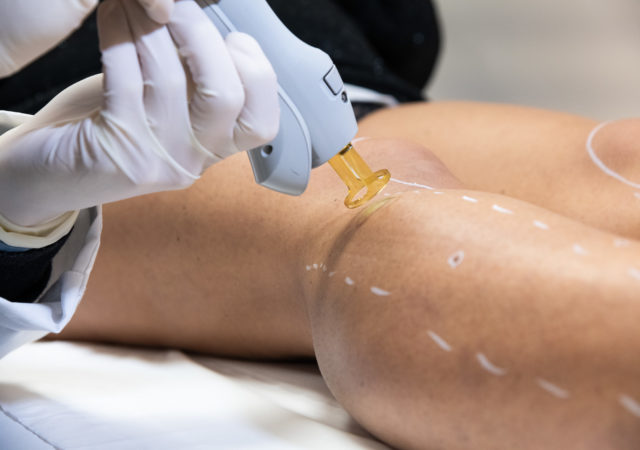 Les avantages de réaliser une épilation laser à Lyon